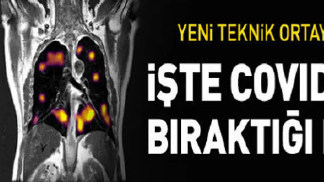 Yeni tarama tekniği, COVID-19'da akciğerlerde oluşan hasarı 'gösterdi'