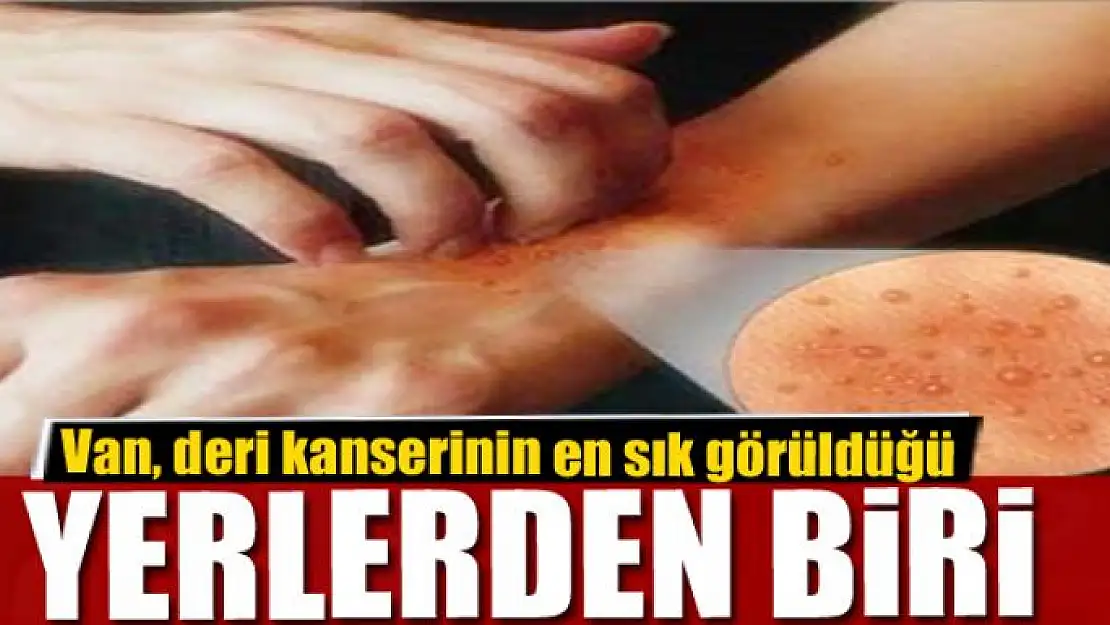 Van, deri kanserinin en sık görüldüğü yerlerden biri