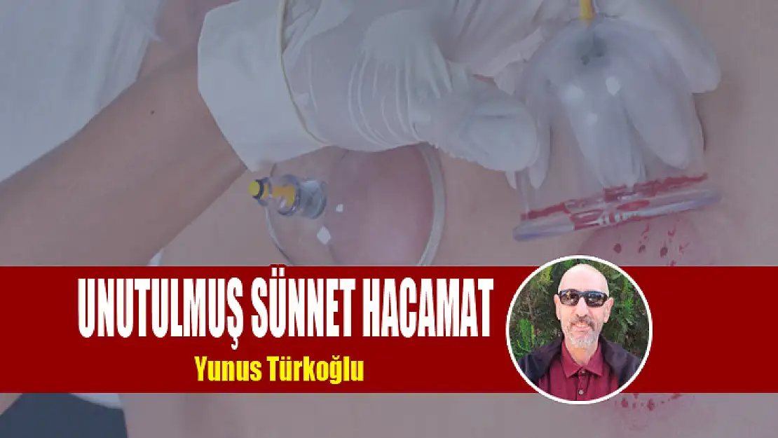 Unutulmuş Sünnet Hacamat