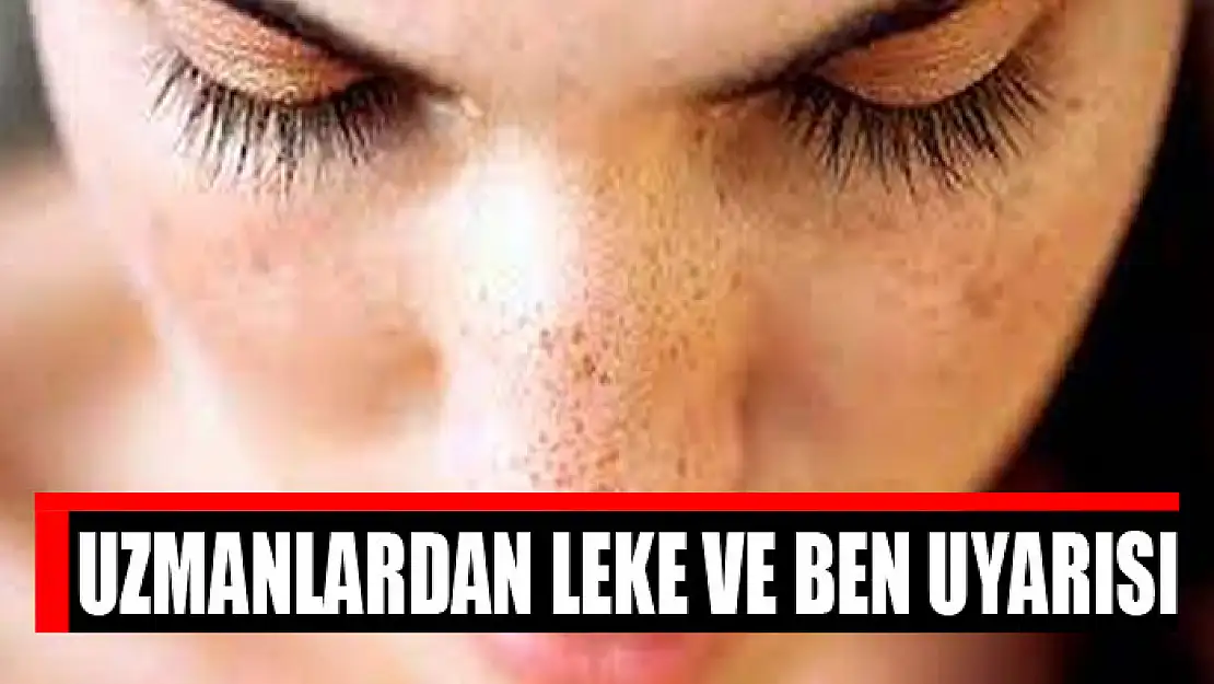 Uzmanlardan leke ve ben uyarısı