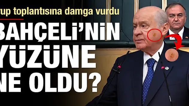 Bahçeli'nin yüzündeki morluk merak konusu oldu