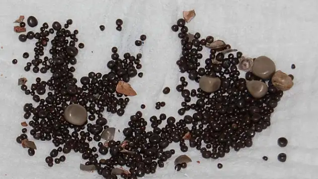 Sağ Böbreğinden 794 Adet Taş Çıktı 