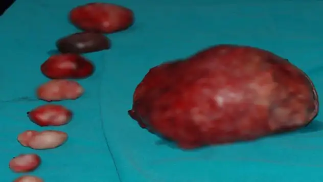 Rahminden 11 tane miyom çıkarıldı