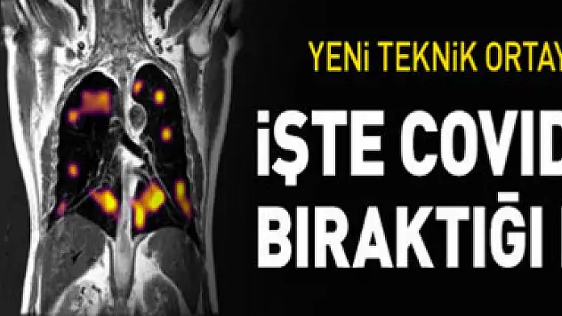 Yeni tarama tekniği, COVID-19'da akciğerlerde oluşan hasarı 'gösterdi'