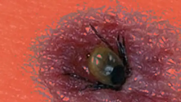 KKKA vakası: Vücuduna yapışan keneyi çıkartan çocuğun testi pozitif çıktı