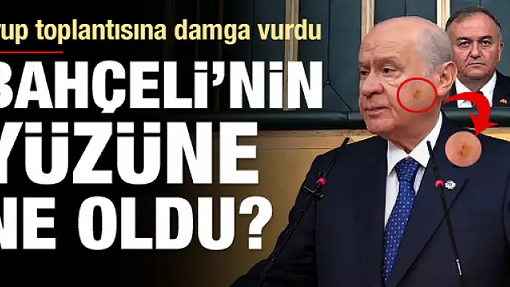 Bahçeli'nin yüzündeki morluk merak konusu oldu
