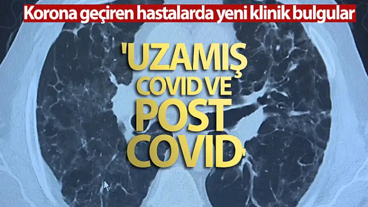 Korona virüs geçiren hastalarda yeni klinik bulgular: 'Uzamış Covid ve post Covid'