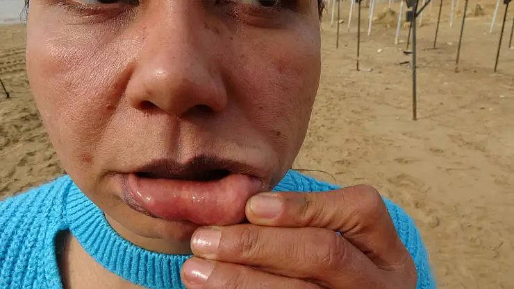 220 bin TL'ye estetik oldu, hayatı kabusa döndü