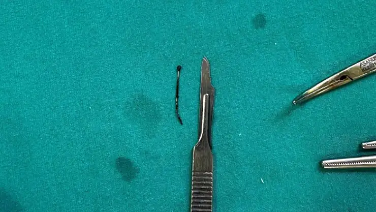 5 yaşındaki çocuğun yuttuğu toplu iğne ameliyatla çıkarıldı