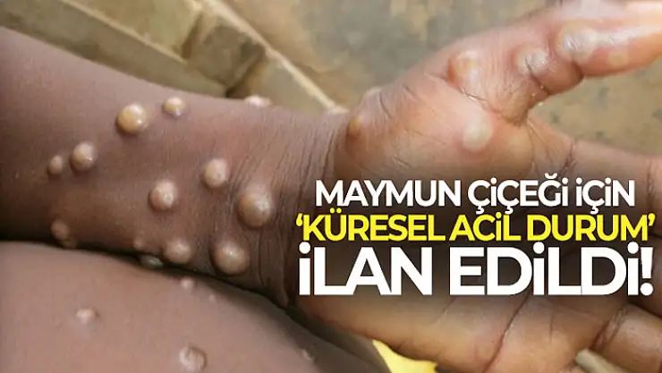 DSÖ, Maymun Çiçeği hastalığını küresel acil durum ilan etti