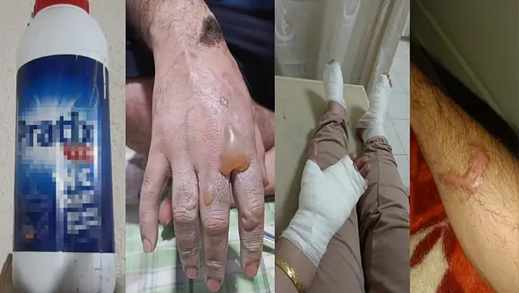Lavabo  açıcı patladı vücutlarında yanıklar oluştu