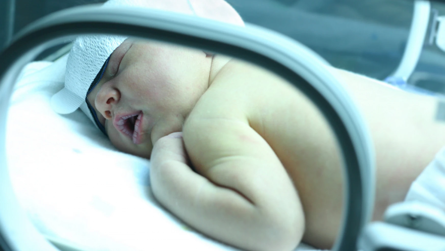 Özellikle Yenidoğan Bebeklerde Sıkça Görülen: Sarılık